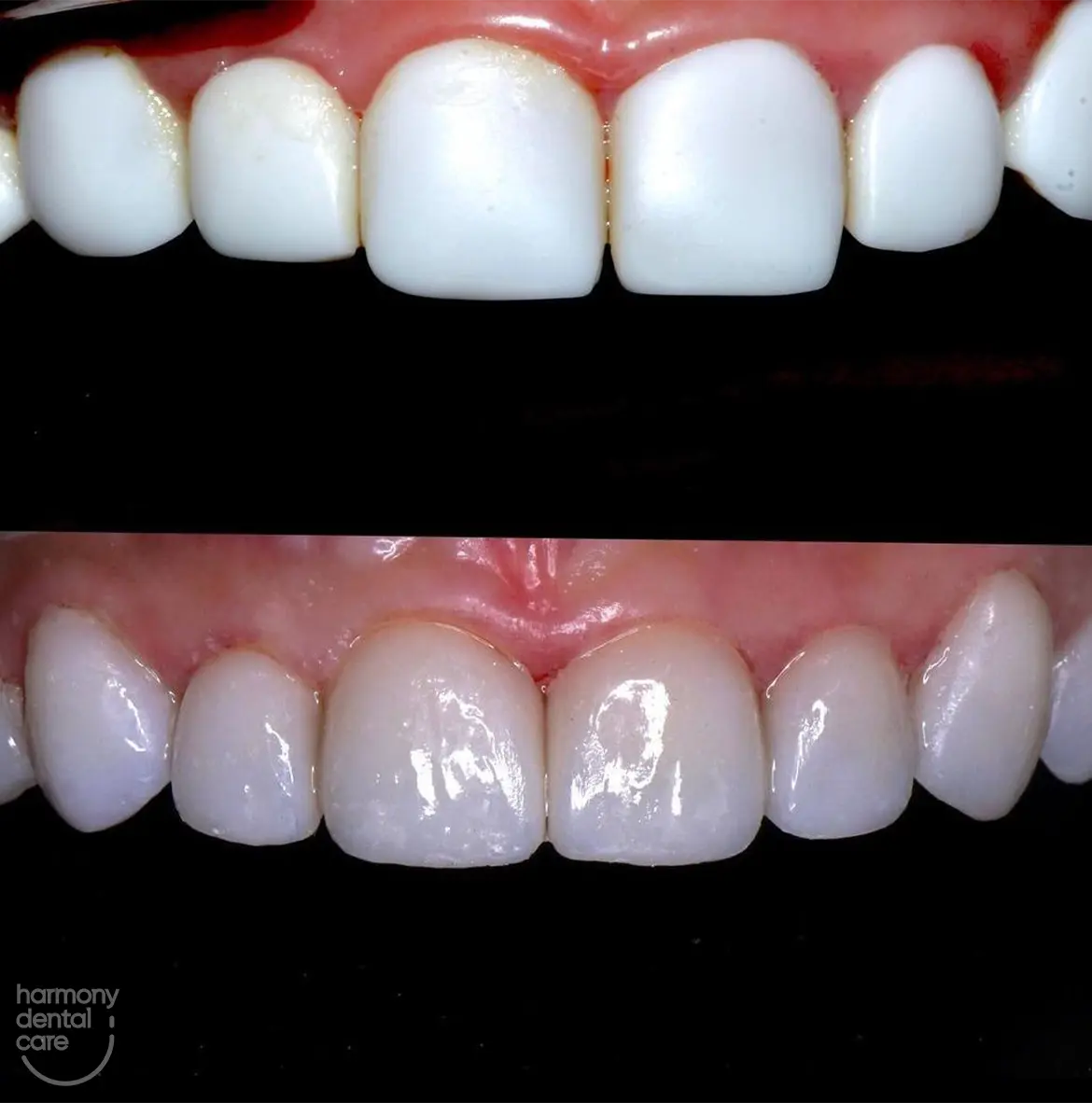 Veneer gigi 1