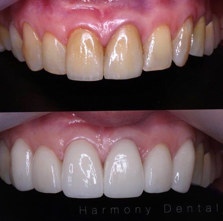 Bleaching Gigi di Jakarta