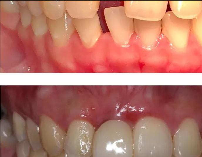 Implan Gigi Jakarta Utara