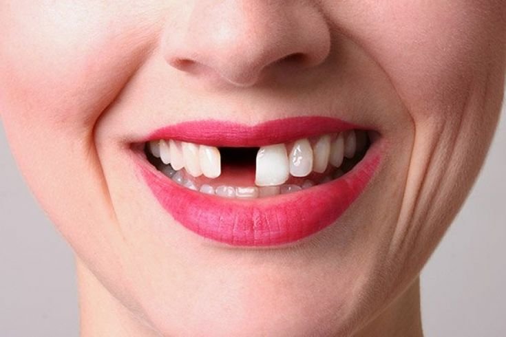 Contoh Crown Gigi Depan