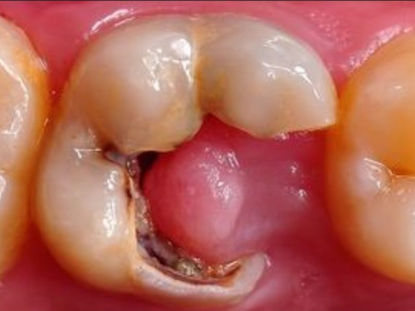 Kenapa Gigi Berlubang Tumbuh Daging