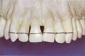 Pengertian Splinting Gigi