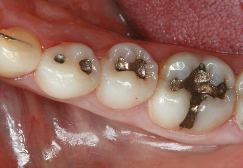 Perbedaan Tambal Gigi Estetik dan Biasa